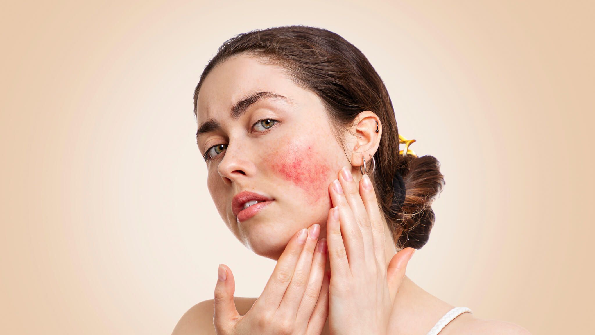 rosacea--priciny--liecba-a-prirodzene-riesenia-1